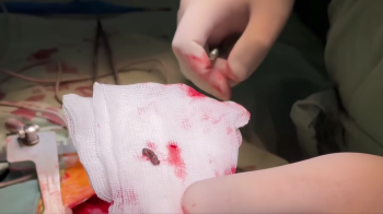 Київські лікарі видалили уламок російської міни з серця 4-річної дівчинки