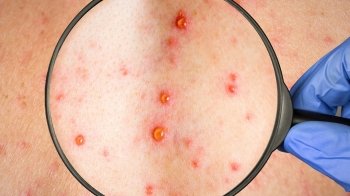 В Україні підтвердили другий випадок захворювання на мавпячу віспу: що відомо