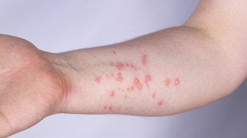 В Україні зафіксували перший випадок мавпячої віспи: що відомо