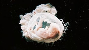 В Індії дівчинка народилася із вісьмома ембріонами всередині