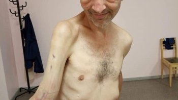 Не вистачає 4 сантиметрів кістки в руці: який стан звільненого із полону морпіха Діанова