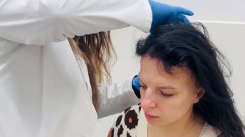 У Львові жінка ледь не облисіла через рідкісне захворювання