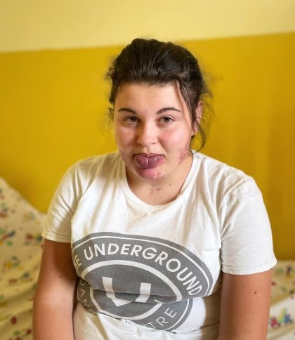 Розпочне нове життя: у Львові медики прооперували дівчинку, яка соромилась зовнішності через пухлину на обличчі