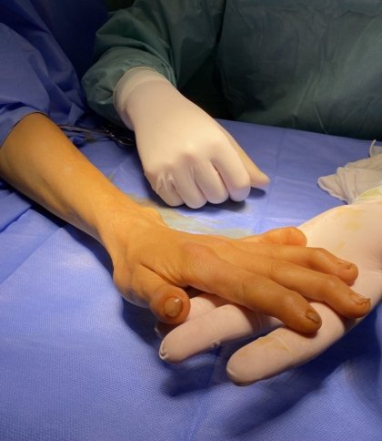 Усе життя ховала руки від чужих очей: львівські лікарі прооперували жінку із рідкісною патологією