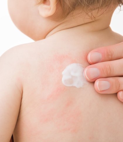 Турбота про шкіру малюка: як упоратися з атопічним дерматитом та алергією