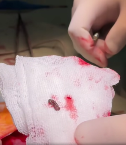 Київські лікарі видалили уламок російської міни з серця 4-річної дівчинки