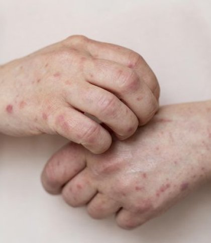 До інфекційної лікарні Львова у важкому стані потрапив 24-річний чоловік з кором