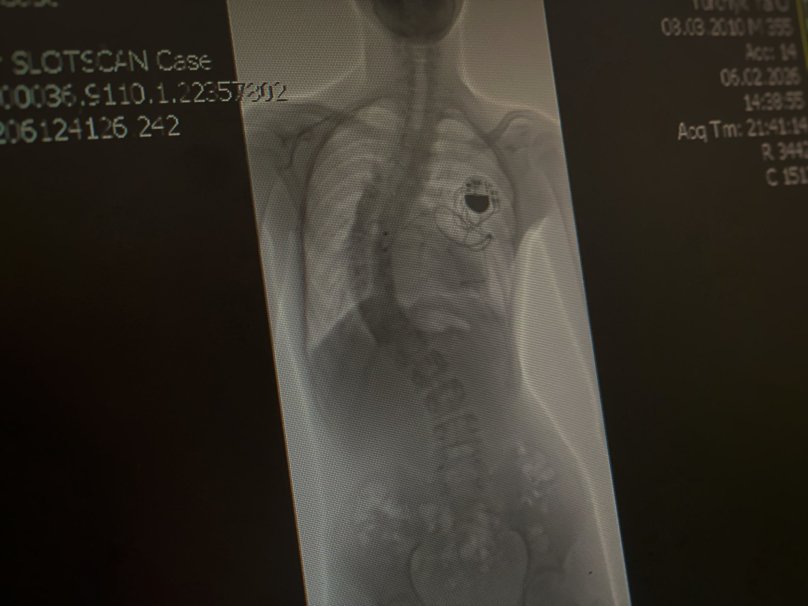 Хребет хлопця на рентгенному знімку