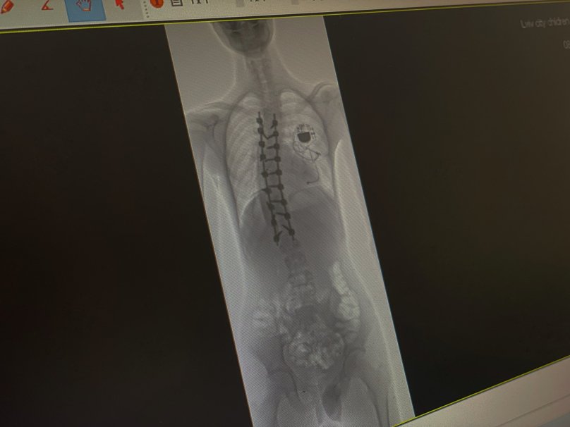 Хребет після операції