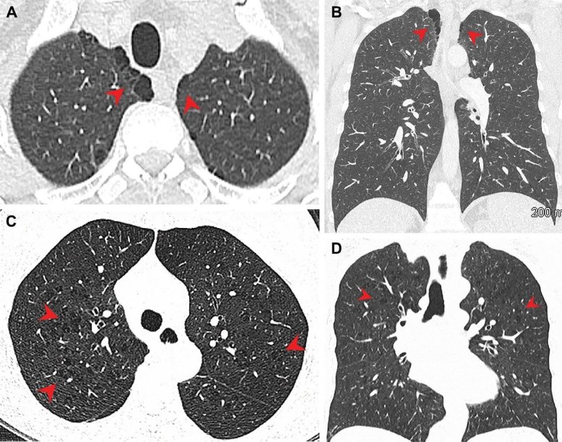 Емфізема легень у (A, B) курців марихуани та (C, D) курців тютюну. (A) Аксіальні та (B) корональні КТ-зображення у 44-річного чоловіка, що курить марихуану, показують парасептальну емфізему (наконечники стріл) у двосторонніх верхніх частках. (C) Аксіальні та (D) корональні КТ-зображення у 66-річної жінки, яка курить тютюн, з центрілобулярною емфіземою, представленою ділянками центролобулярної прозорості (стрілки). Фото: Радіологічне товариство Північної Америки