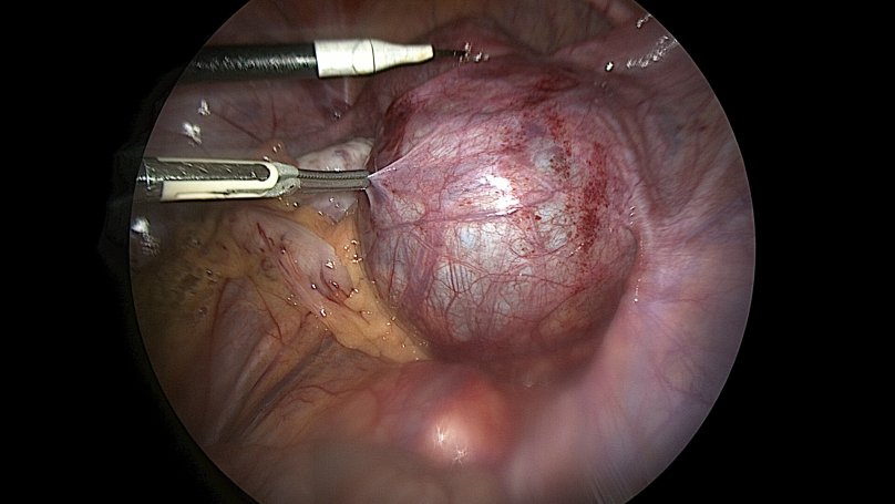 Фото кісти у 16-річної дівчини