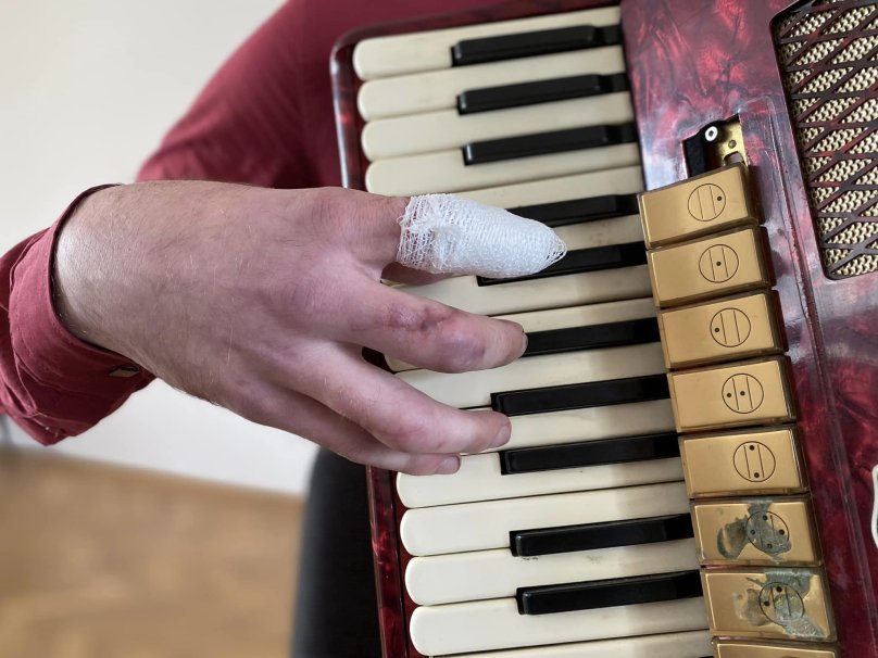 Травмував руку під час роботи із верстатом: львівські хірурги врятували пальці вчителю музики – 01