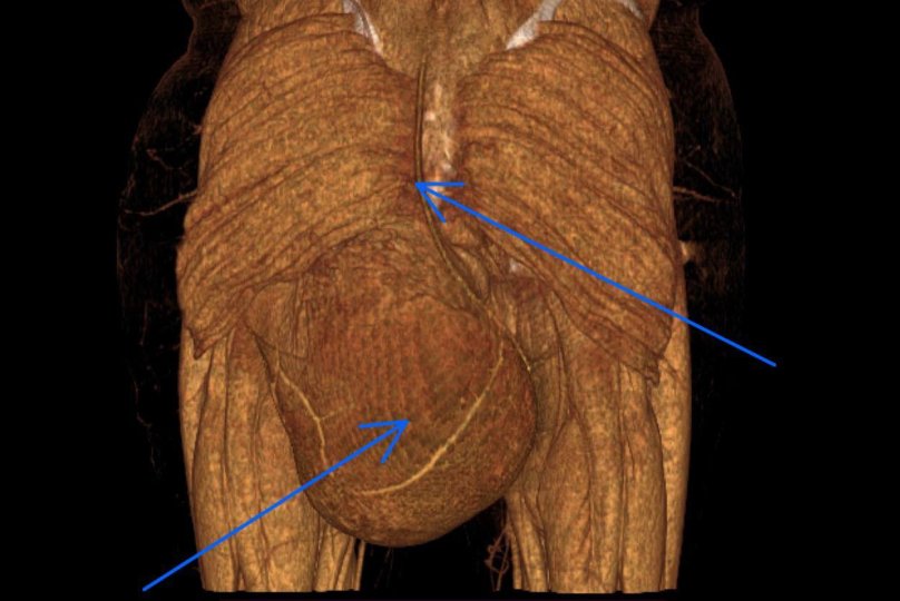 Пухлина поширилася у порожнину малого тазу