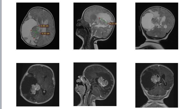 Львівські медики успішно видалили небезпечну пухлину мозку у двомісячної дівчинки – 01