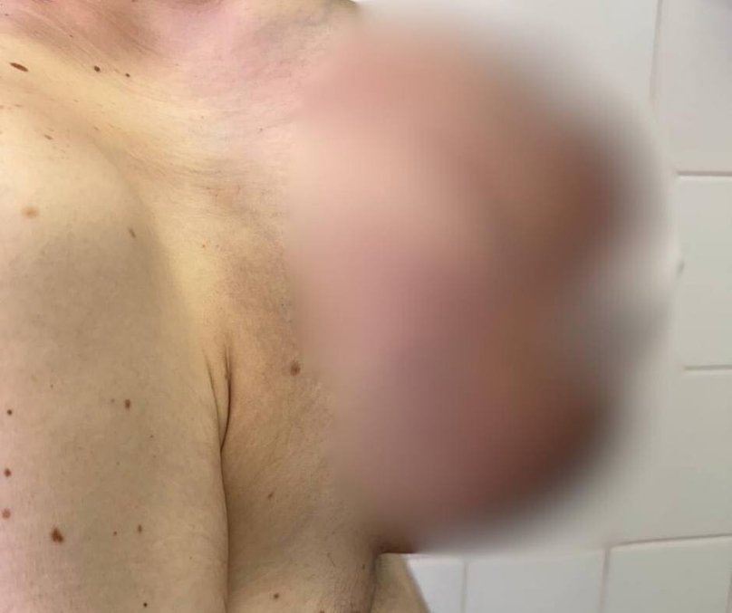 Лікарі Львівського онкоцентру видалили пацієнту пухлину вагою 10 кг – 01