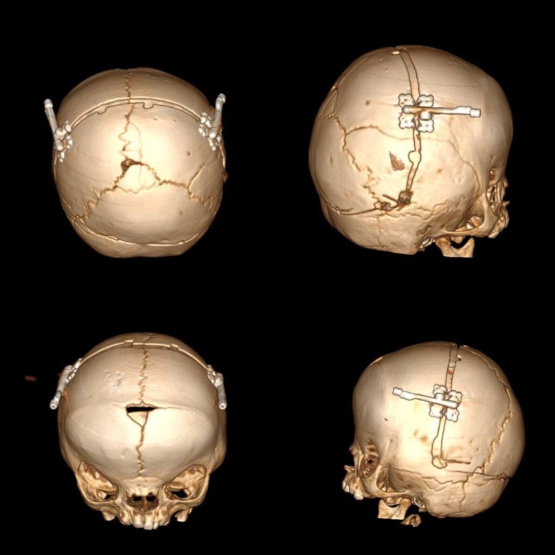 Проекція металевих конструкцій у черепі 