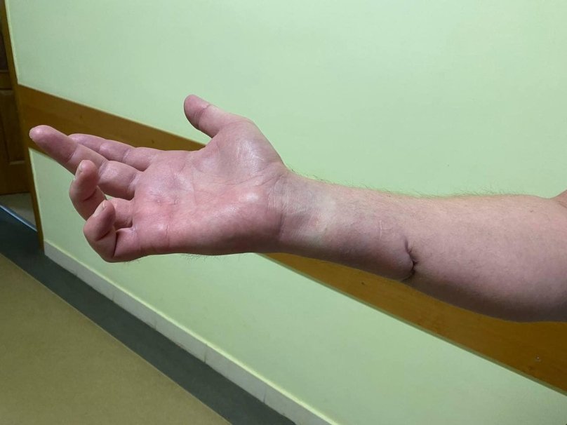 Пересадили нерв зі стегна, аби пальці могли рухатись: у Львові лікарі врятували руку захиснику – 01
