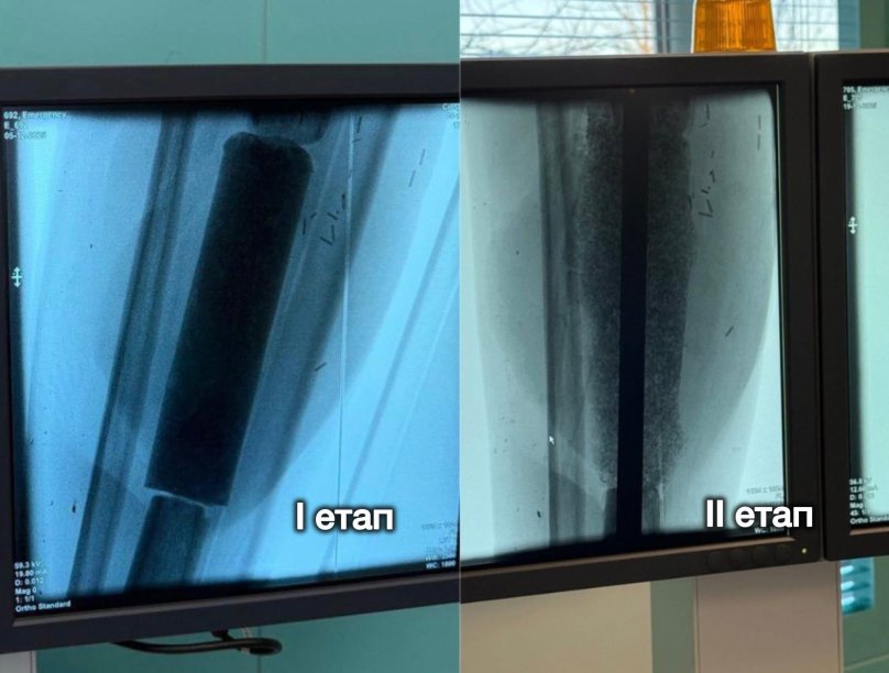 У львівському госпіталі військовому відновили 12,5 см зруйнованої кістки за новою методикою – 01