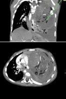 Дихала однією легенею: львівські лікарі врятували дівчинку зі складною пухлиною – 01
