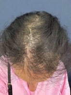 У Львові жінка ледь не облисіла через рідкісне захворювання – 01