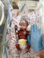 У Львові медики вперше зробили операцію на мозку новонародженої дитини вагою 750 грамів – 01