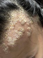 У Львові жінка ледь не облисіла через рідкісне захворювання – 02