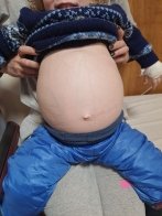 Медики зі Львова успішно видалили 2-річному хлопчику з Краматорська нирку з пухлиною – 02