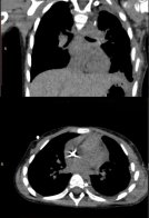 Дихала однією легенею: львівські лікарі врятували дівчинку зі складною пухлиною – 02