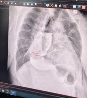 Два випадки на 100 тисяч: у Львові прооперували жінку з рідкісною патологією стравоходу – 04