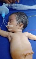 В Індії дівчинка народилася із вісьмома ембріонами всередині – 01