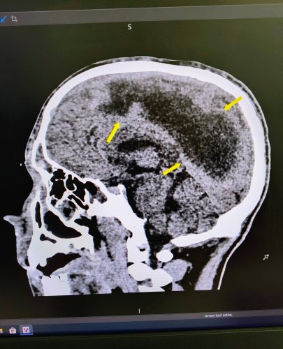 Львівські медики врятували 16-річного хлопця, який впав у кому через гній у мозку – 01