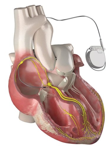 У Львові вперше “перезапустили” серце новою високоточною стимуляцією – 01