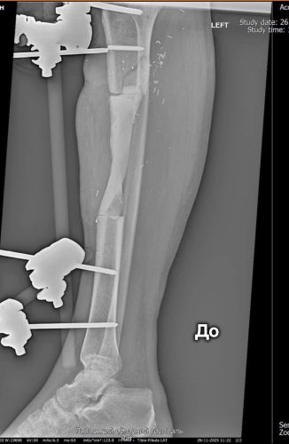 У львівському госпіталі військовому відновили 12,5 см зруйнованої кістки за новою методикою – 02