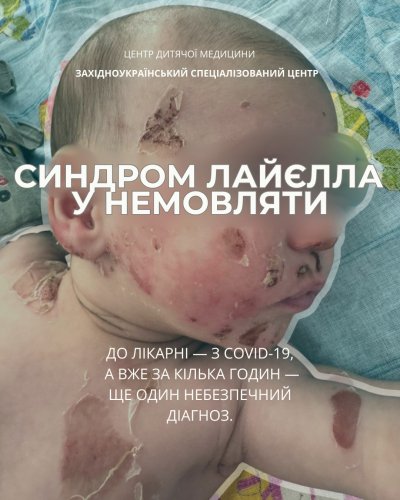 У Львові в одномісячного немовляти з COVID-19 виявили токсичне ураження шкіри – 01