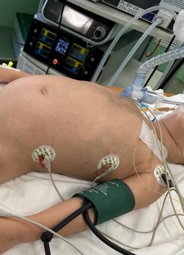 У Львові хірурги видалили 4-річному хлопчику пухлину діаметром 20 см – 01