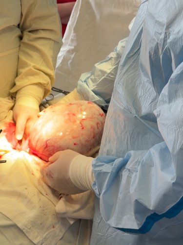 Операція з видалення кісти