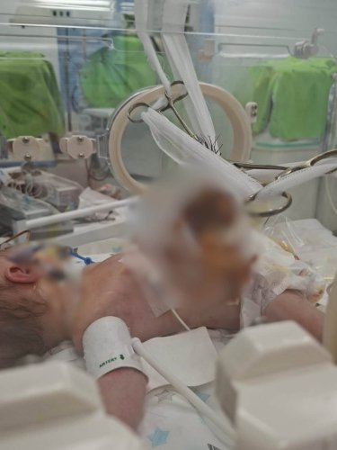 У Львові медики врятували немовля, яке народилося із органами назовні – 01