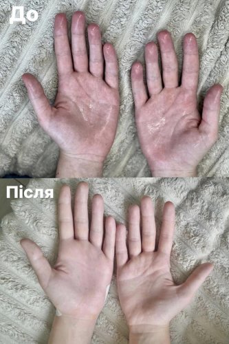Руки дівчини до операції та після. Фото: Львівська обласна дитяча клінічна лікарня «Охматдит»