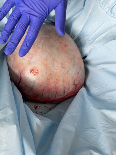 Операція з видалення кісти