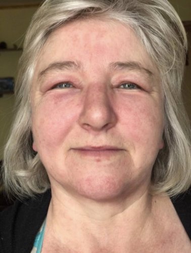 Після нападу собаки жінці з Львівщини діагностували дерматоміозит – 01