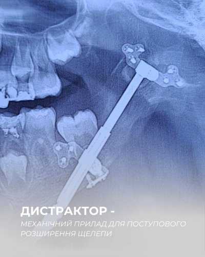 У Львові прооперували дівчинку з рідкісним синдромом Гольденхара – 01