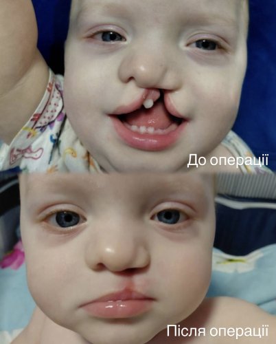 У Львові лікарі відновили однорічній дитині губу та піднебіння – 01
