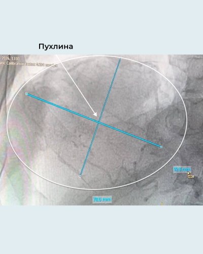 Львівські лікарі зупинили рак 4 стадії з метастазами в донорській печінці – 01