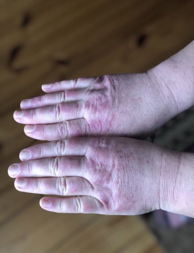 Після нападу собаки жінці з Львівщини діагностували дерматоміозит – 02