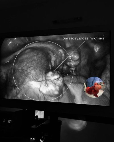 Львівські лікарі вперше в Україні видалили рідкісну пухлину з рудименту матки – 01