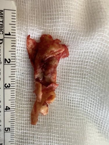 У Львові хірурги попередили інсульт у 61-річного чоловіка з критичним звуженням сонних артерій – 01