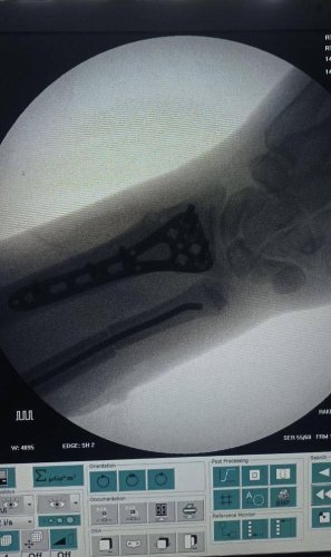 У львівському “Охматдиті” прооперували підлітка, який три місяці приховував перелом – 01